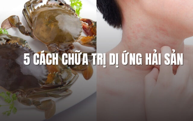 5 cách chữa trị dị ứng hải sản tại nhà