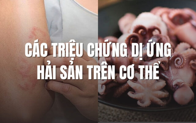 Các triệu chứng dị ứng hải sản trên cơ thể